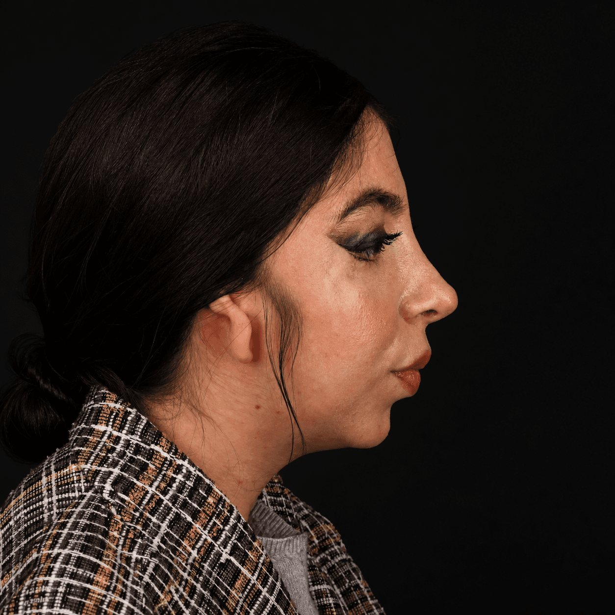 بازسازی نواقص صورت — مورد 2 — بعد