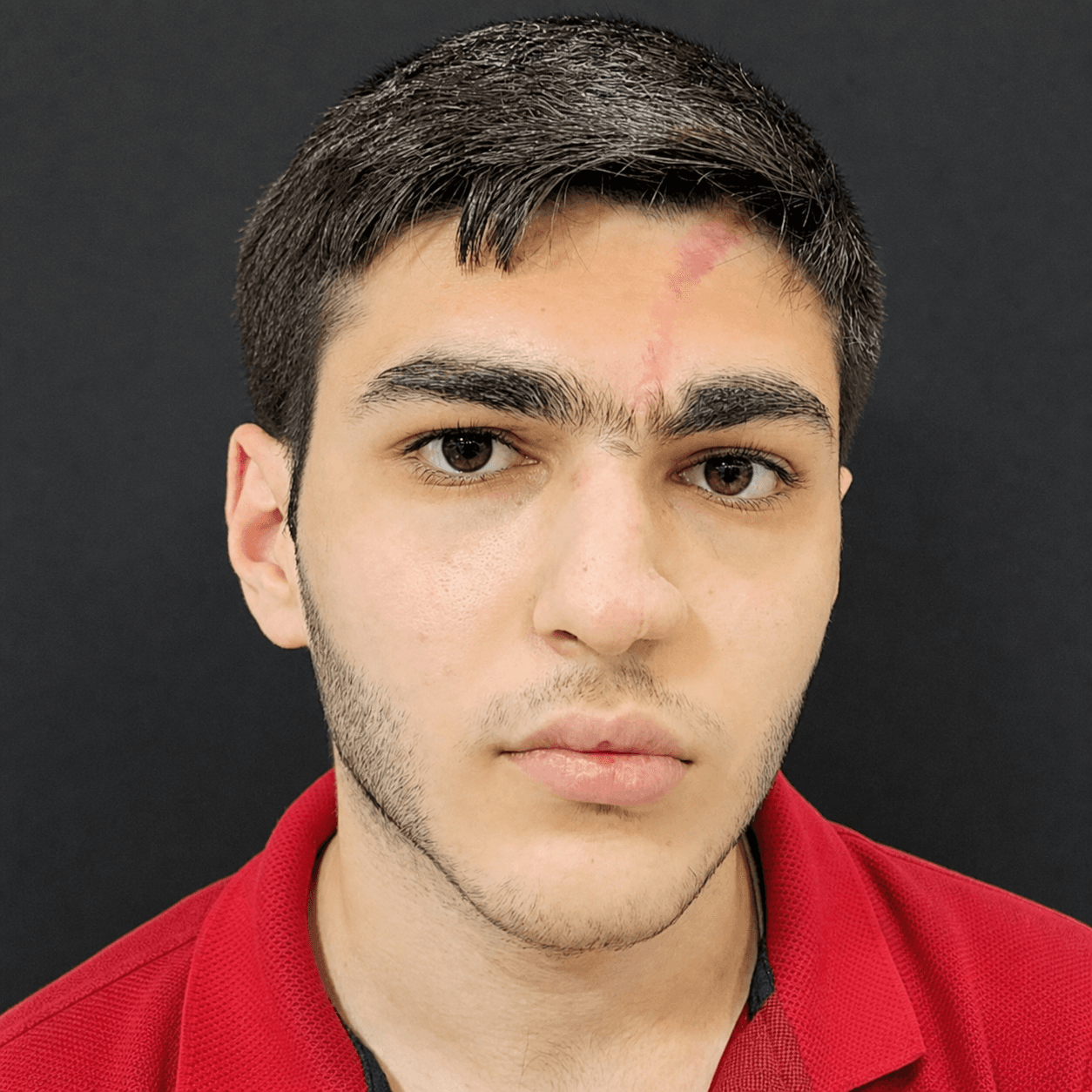 بازسازی نواقص صورت — مورد 4 — بعد