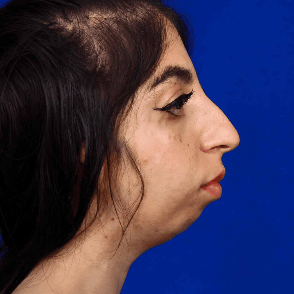 بازسازی نواقص صورت — مورد 2 — قبل