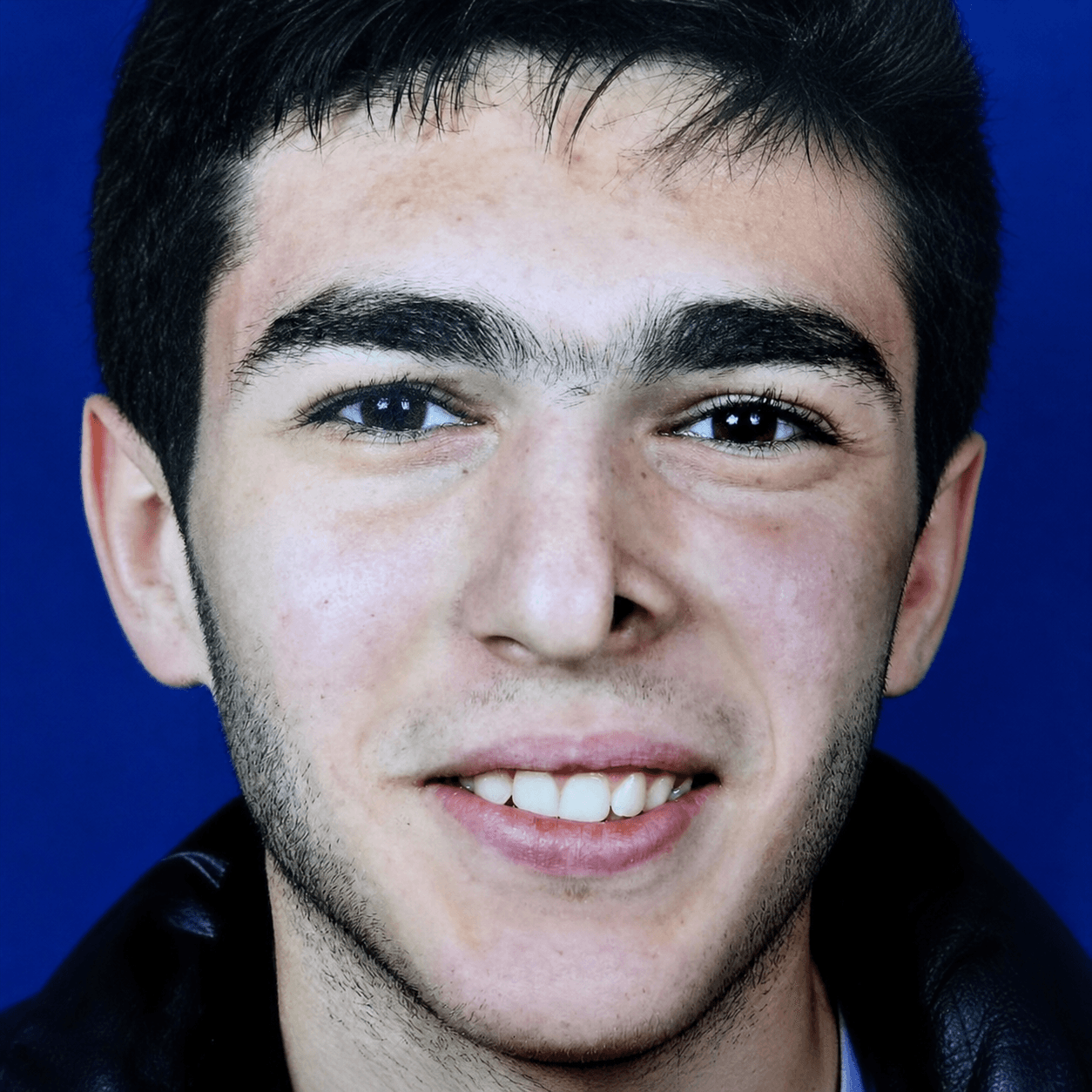 بازسازی نواقص صورت — مورد 4 — قبل