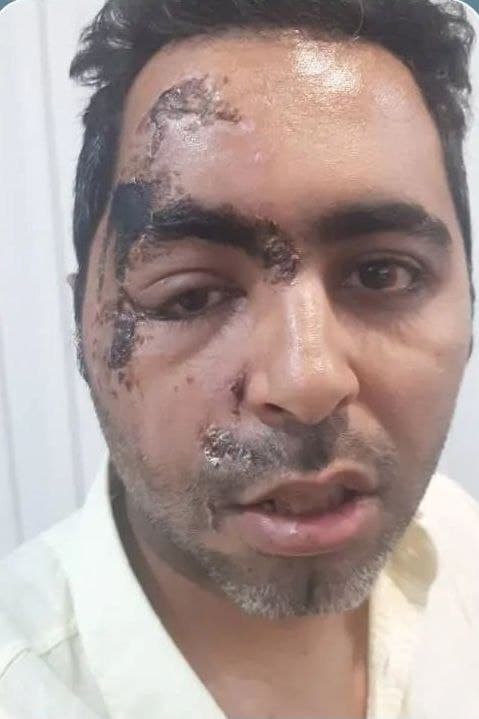 بازسازی نواقص صورت — مورد 5 — قبل