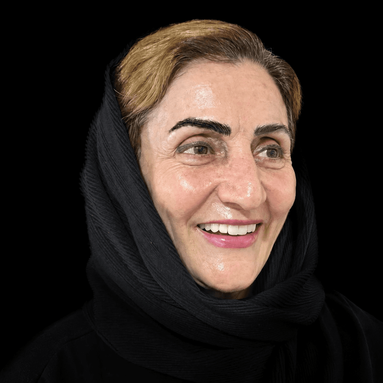 ایمپلنت — مورد 1 — بعد