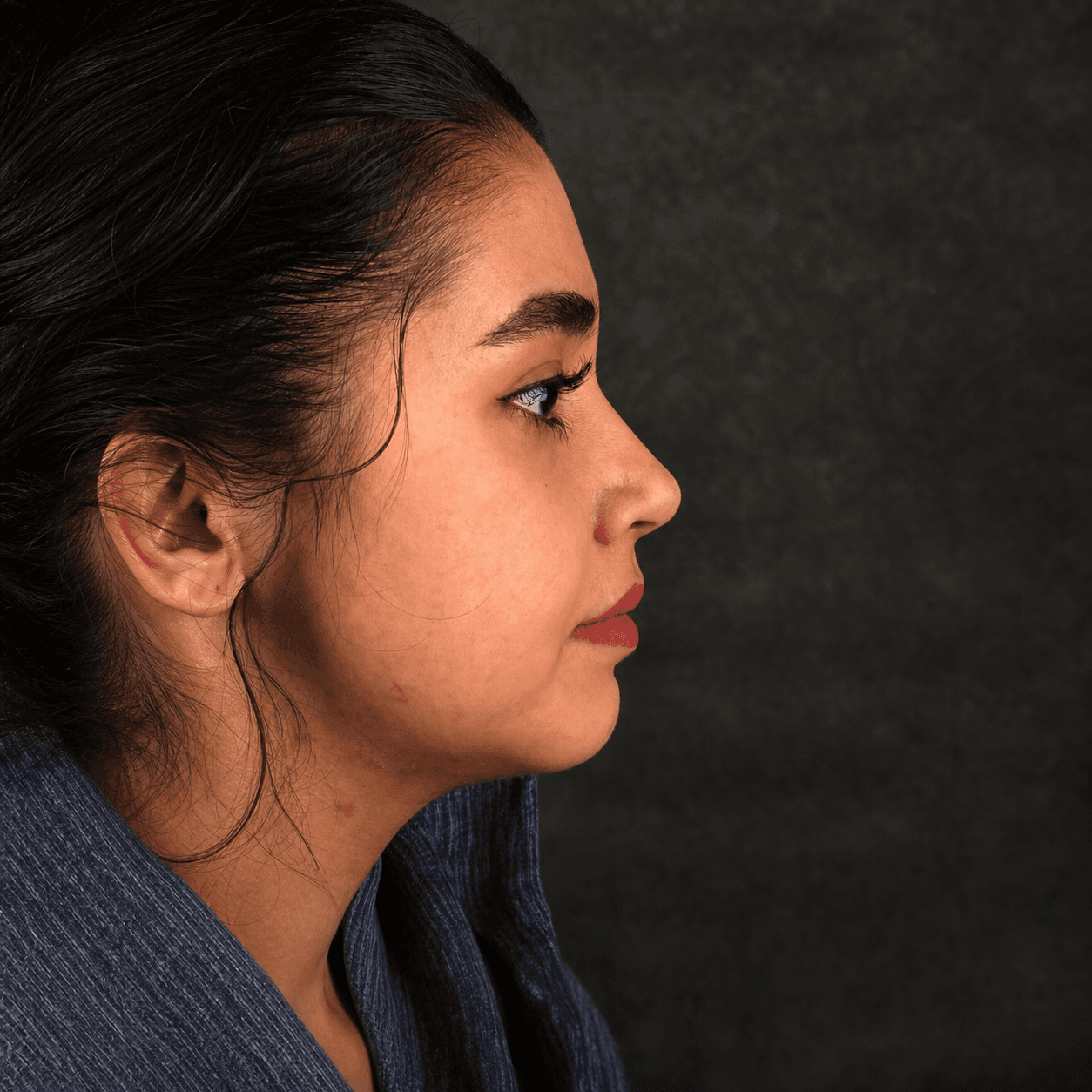 جراحی فک — مورد 2 — بعد