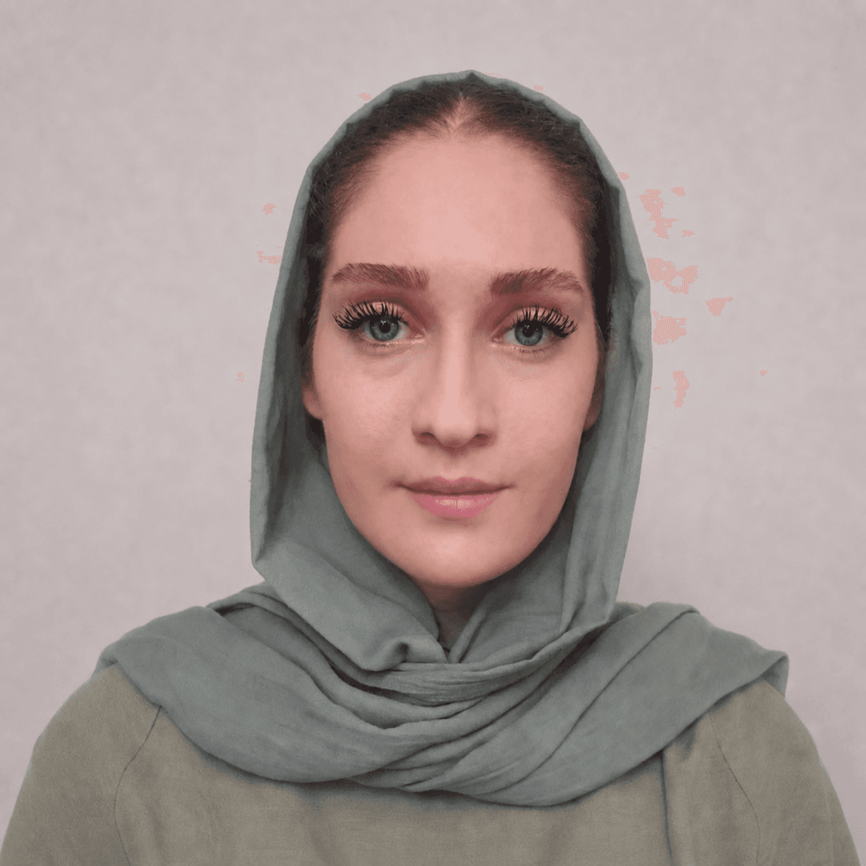 جراحی فک — مورد 10 — بعد