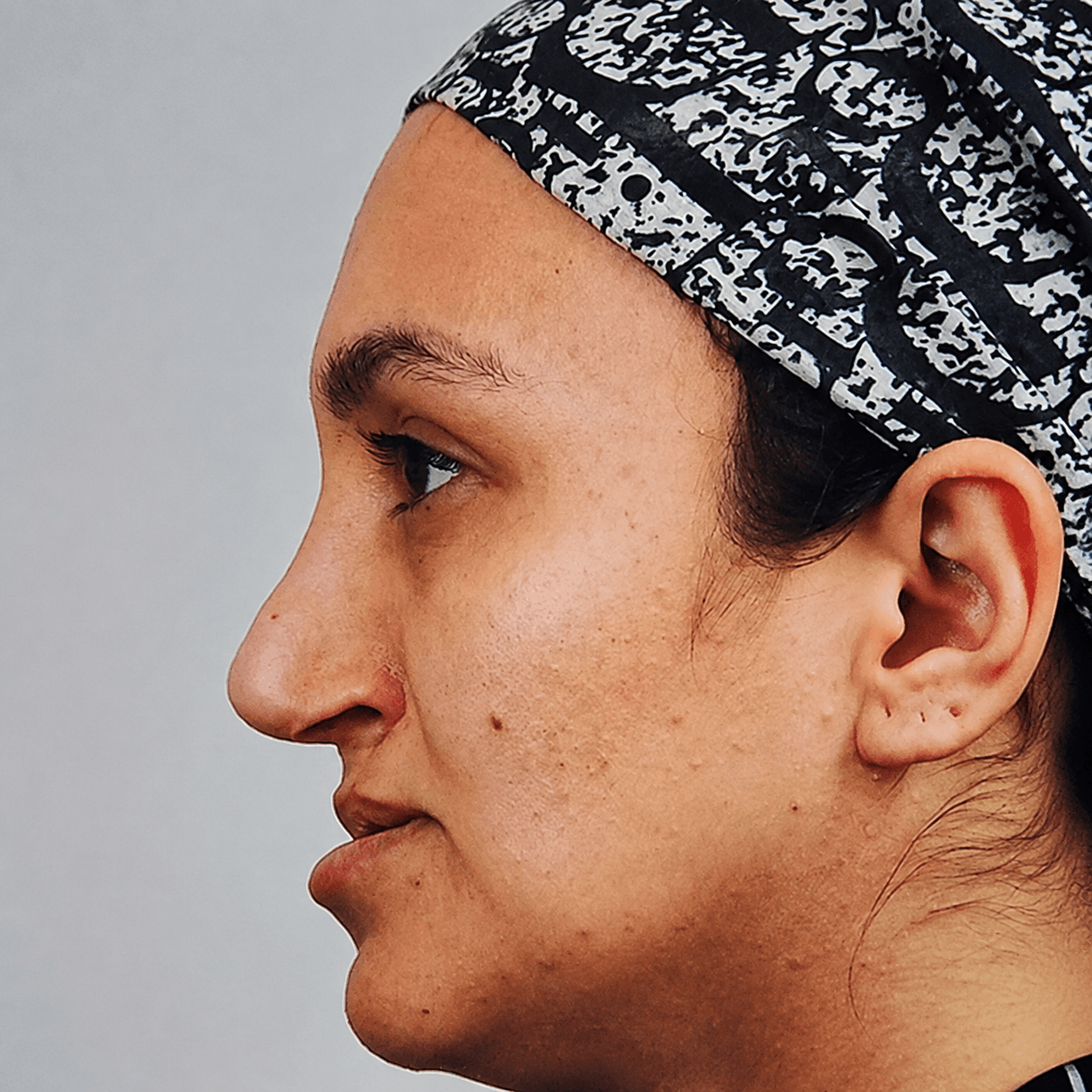 جراحی فک — مورد 5 — قبل