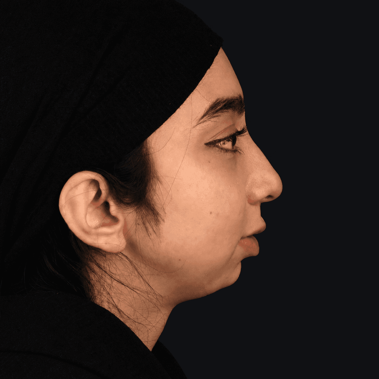 جراحی فک — مورد 6 — قبل
