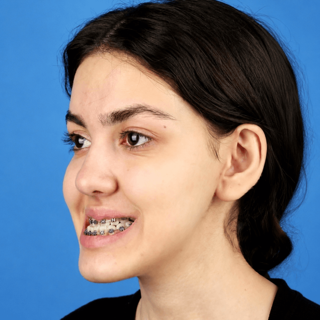 جراحی فک — مورد 8 — قبل