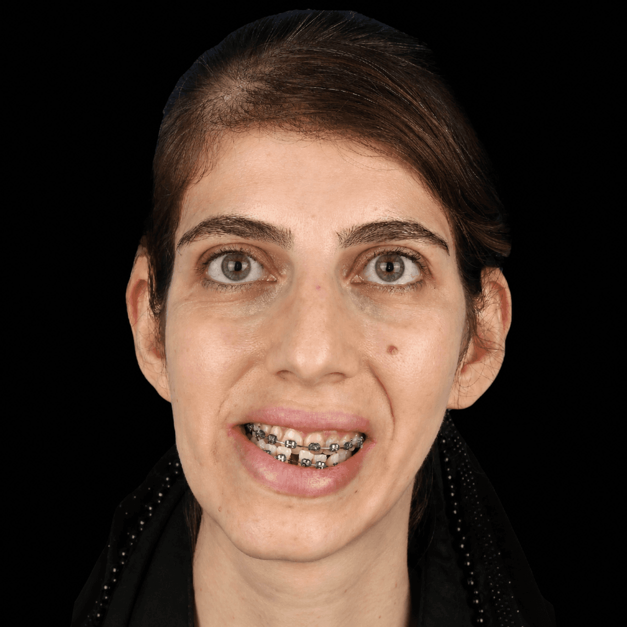 جراحی فک — مورد 9 — قبل