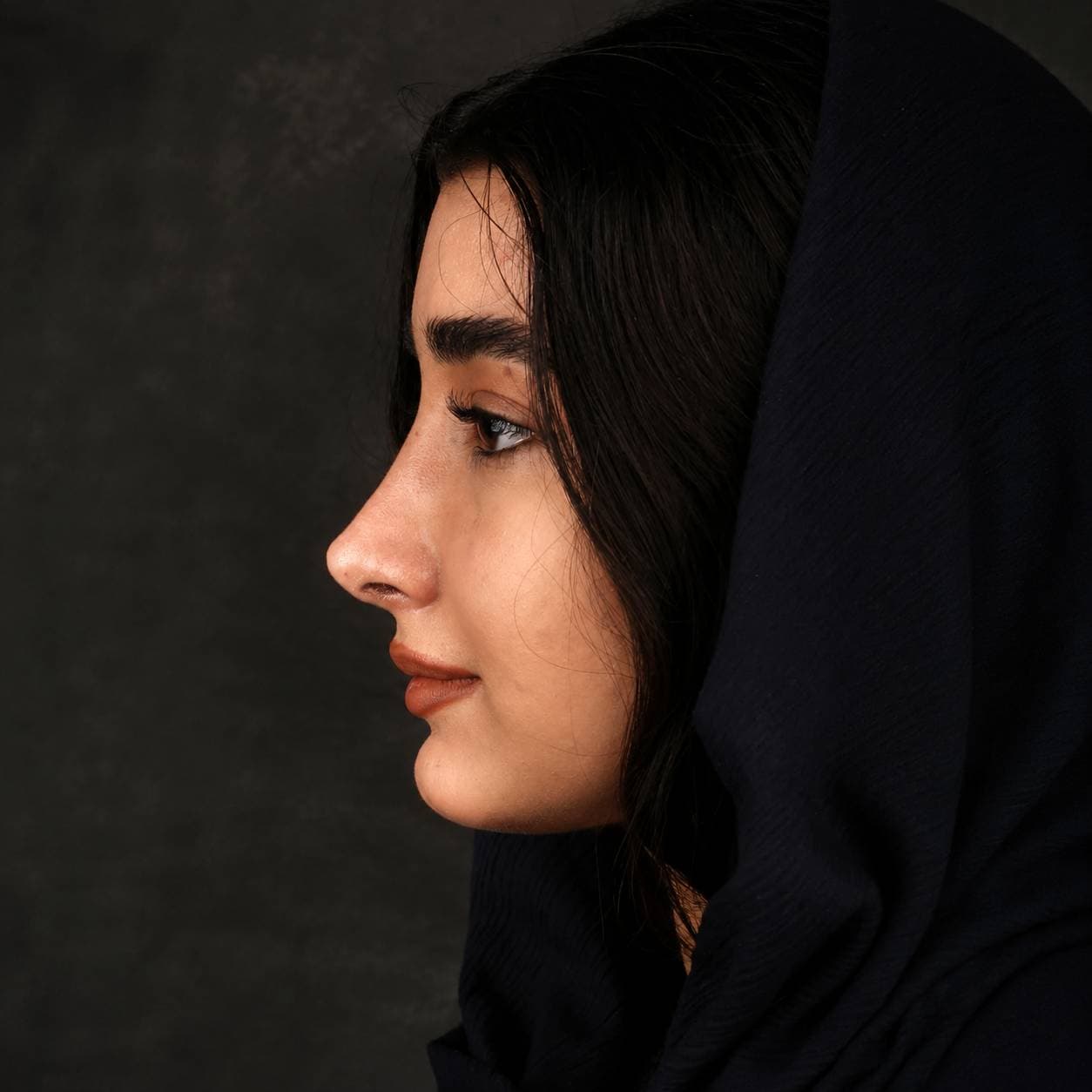 جراحی بینی — مورد 5 — بعد