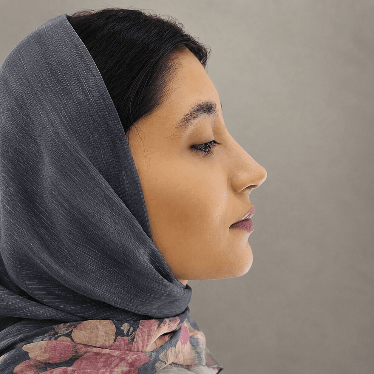 جراحی بینی — مورد 2 — بعد