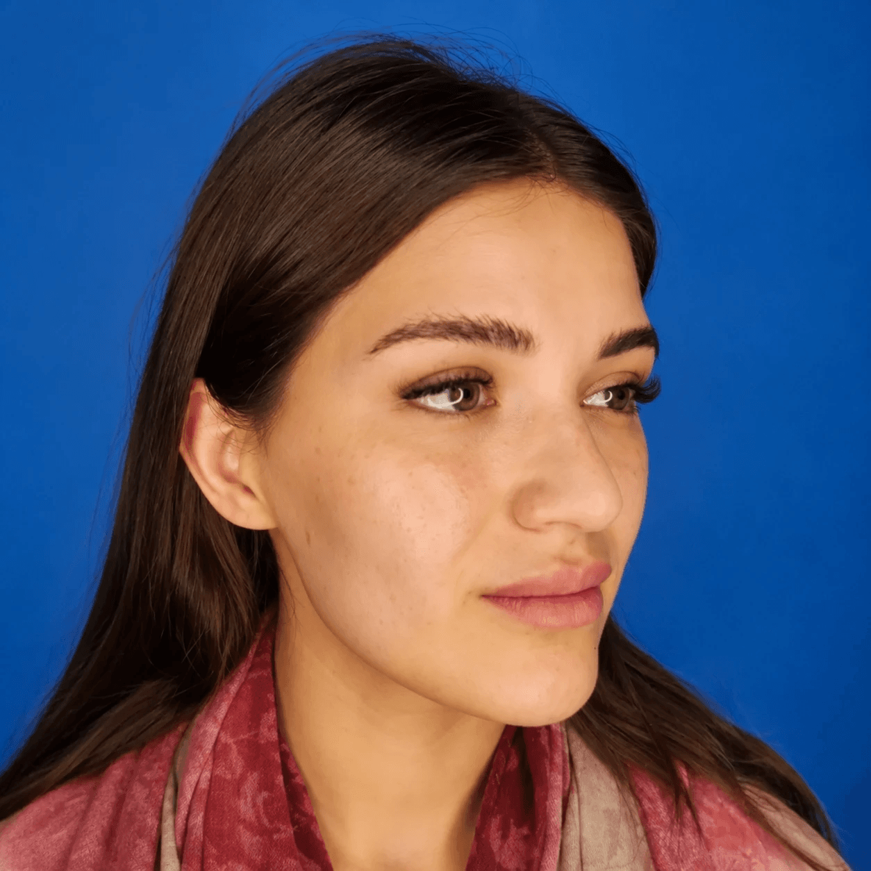 جراحی بینی — مورد 6 — قبل