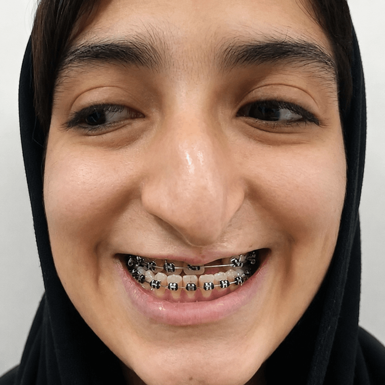 بازسازی نواقص صورت — مورد 1 — قبل