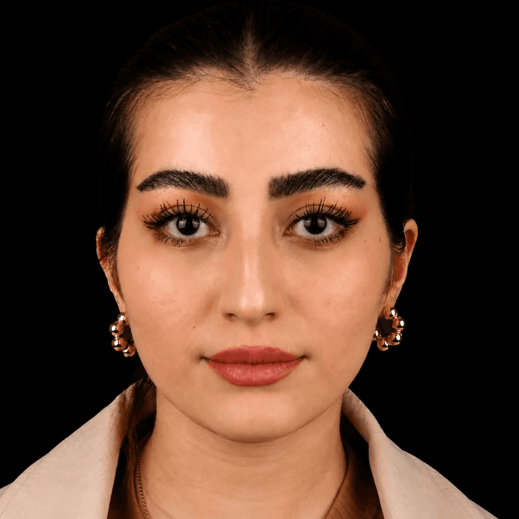 جراحی فک — مورد 1 — بعد