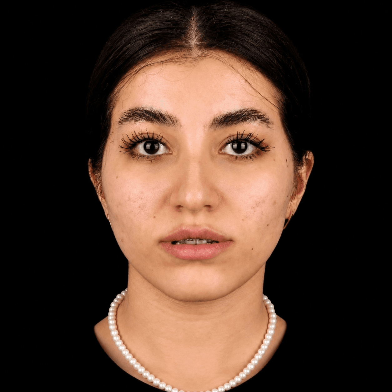 جراحی فک — مورد 1 — قبل