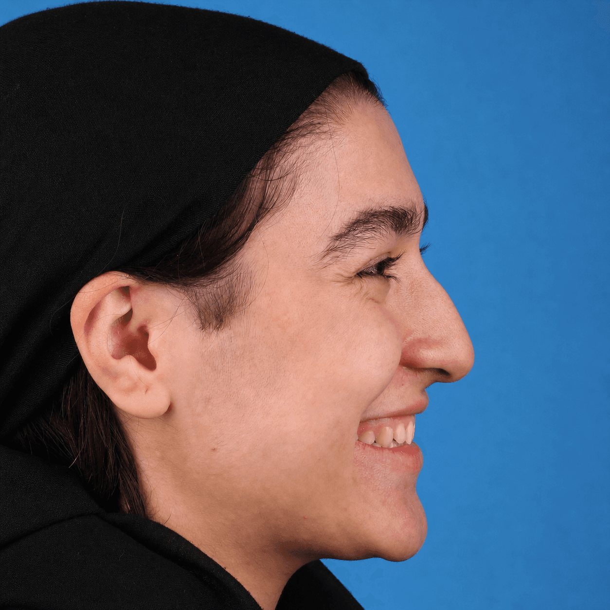 جراحی بینی — مورد 1 — قبل