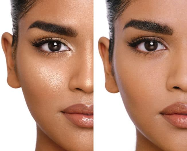 لیفت شقیقه گلایدینگ؛ روش کمتهاجمی برای جوانسازی اطراف چشم و شقیقه